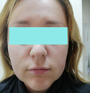 после SMAS-лифтинга