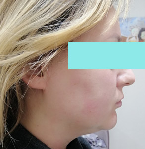 После процедуры СМАС-лифтинга