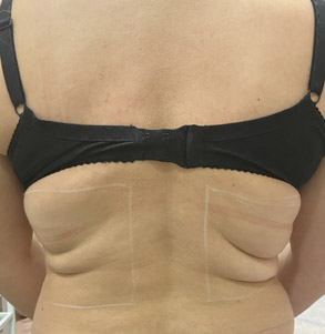 SMAS спина до процедуры