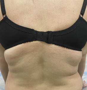 SMAS спина после процедуры