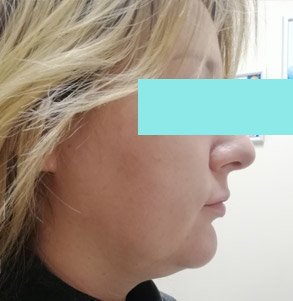 до СМАС-лифтинга