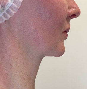 SMAS после процедуры