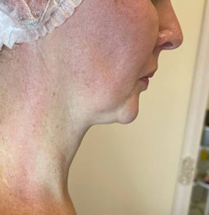 SMAS до процедуры