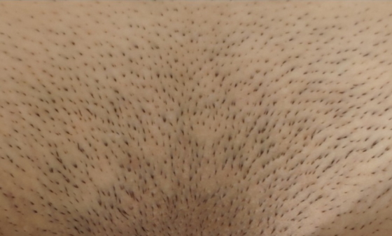 лазерная эпиляция бикини до