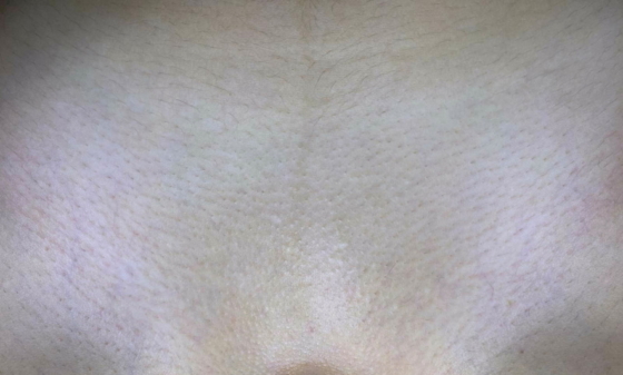 лазерная эпиляция бикини после