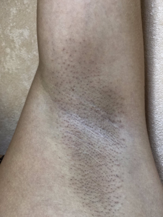 лазерная эпиляция подмышек до