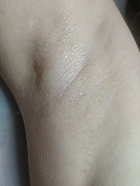 подмышки после 10 сеансов лазерной эпиляции