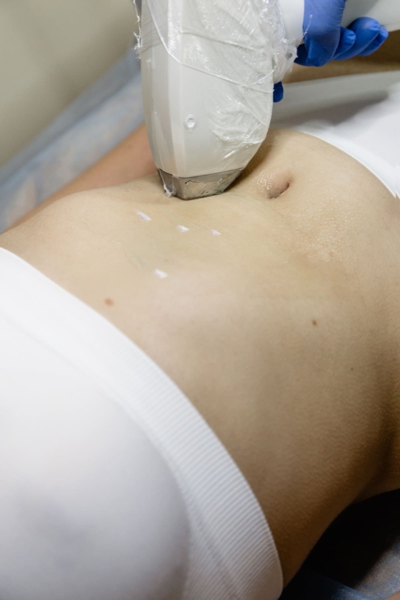 лазерная эпиляция живота