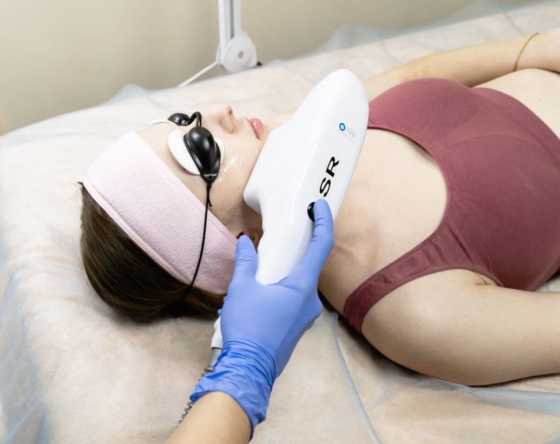 лазерная эпиляция лица