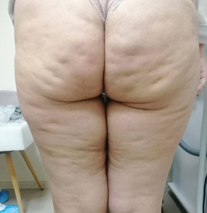 До процедури SMAS-ліфтингу