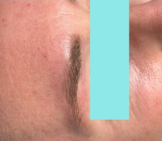 После удаления перманентного макияжа