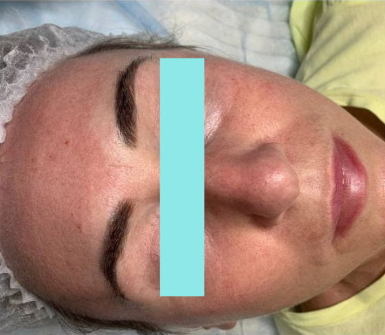 До удаления макияжа перманентного