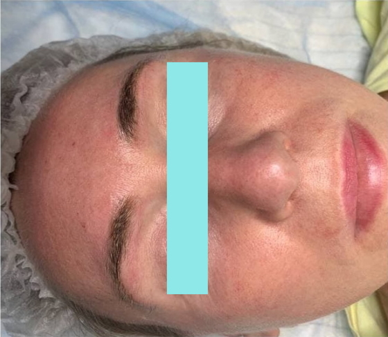 После удаления макияжа перманентного